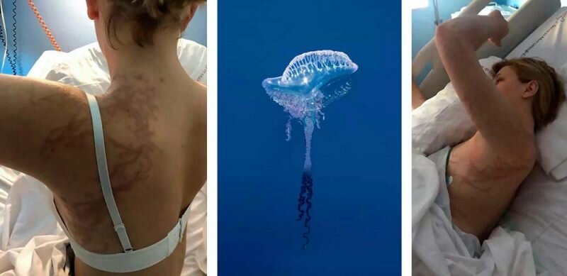 Женщина получила ужасные травмы после того, как её укусила медуза   Интересное