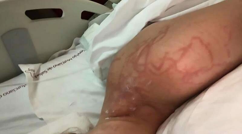 Женщина получила ужасные травмы после того, как её укусила медуза   Интересное