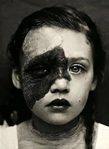 Поразительные фото пациентов из XIX века, страдающих от тяжких болезней интересное