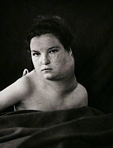 Поразительные фото пациентов из XIX века, страдающих от тяжких болезней интересное