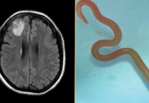 Діагностична дилема: за інфекцією легенів жінки, пошкодженням органів і забудькуватістю стояв паразит, який ніколи раніше не зустрічався у людей